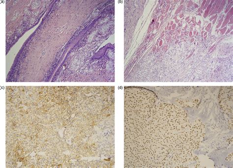 Clear Cell Myoepithelial Carcinoma Of Minor Salivary Gland A Case