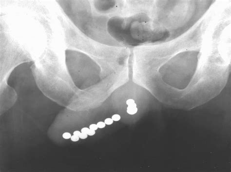 Ray Of The Pelvis Showed Multiple Metallic Objects Approximately 1 Cm