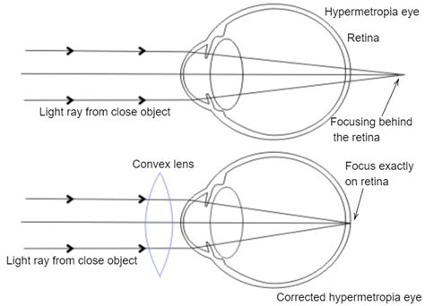 Draw Ray Diagrams Each Showing I Myopic Eye And Ii Hypermetropic Eye