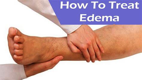 Edema Causes Flash Pulmonary Corneal Peripheral Treatment