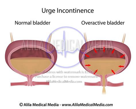 Alila Medical Media Urge Urinary Incontinence In Women Medical