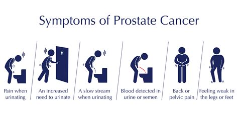 prostate cancer symptoms diagnosis and treatment in sydney katelaris urology