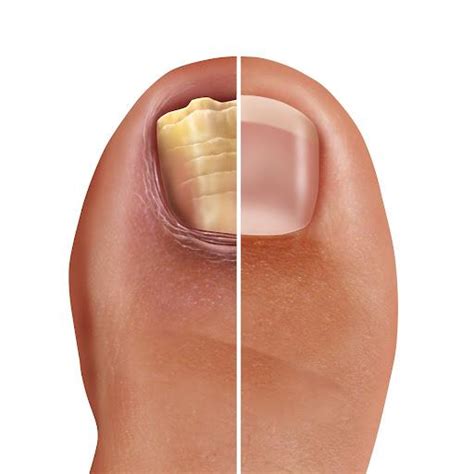 The Dermatologist Guide To Recognizing And Treating Toenail Fungus Stride