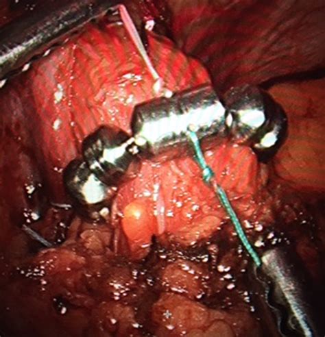 Laparoscopic Management Of Reflux After Roux En Y Gastric Bypass Using