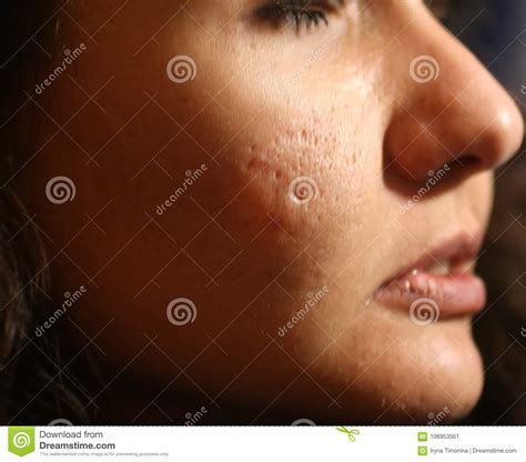 Inflamed Skin Of The Face In Pimples And Acne Keloid Scars From Acne