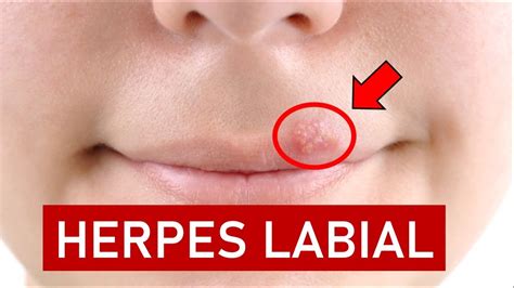 Herpes Labial Ou Espinha