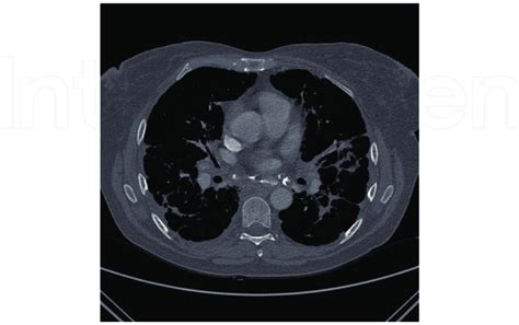 Calcified Mediastinal Lymphadenopathy With Bilateral Hilar Nodal