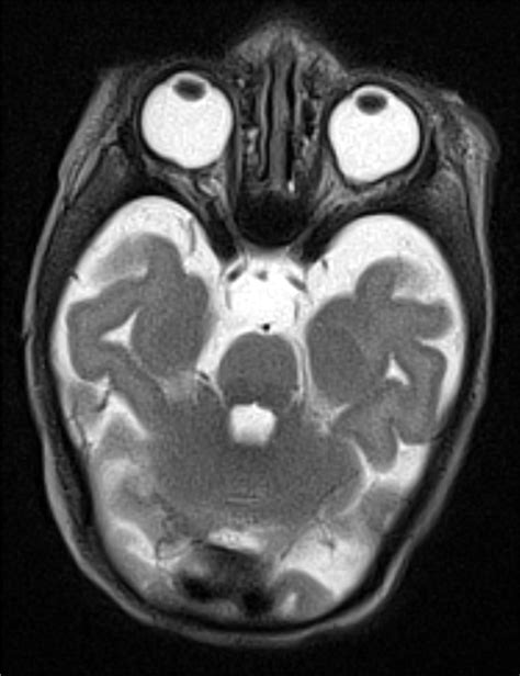 T2 Weighted Mri Of The Brain Without Contrast Taken On Day Of Life 14