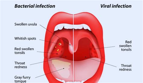How To Cure Strep Throat Naturally Know The Health Tips