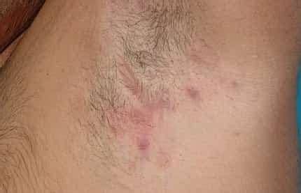 Reddit has some pretty strong opinions. Causes of Underarm Rashes | IYTmed.com