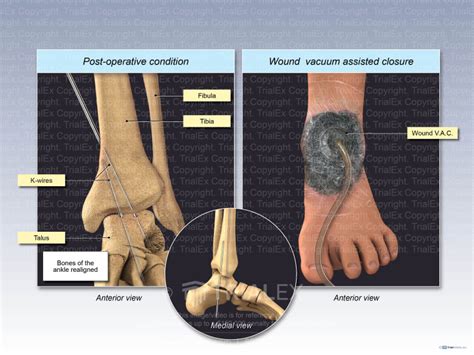 Surgical Repair Of The Left Ankle Trial Exhibits Inc