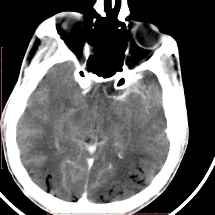 Cerebral Air Embolism Radiology Case Radiopaedia Org