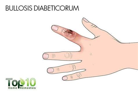 Common Skin Problems Linked To Diabetes Top 10 Home Remedies