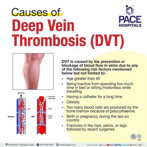 Deep Vein Thrombosis Dvt Symptoms Causes And Off