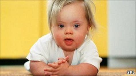 IVF Procedure May Increase Risk Of Down S Syndrome BBC News
