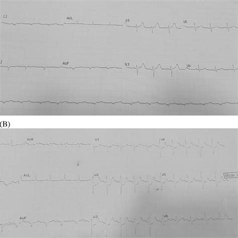 A B Ecg Showing Downsloping St Depression From V1 To V6 Download