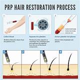 Photos of Blood Platelet Hair Loss Treatment