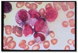 La leucemia lleva a un aumento incontrolable de la cantidad de glóbulos blancos. Leucemia mieloide aguda - EcuRed