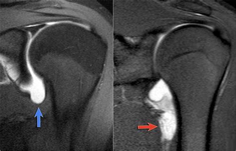 The Radiology Assistant Shoulder Instability Mri