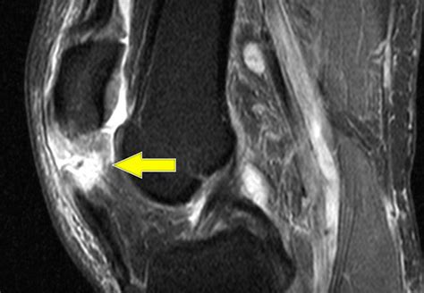 Ruptured Patellar Or Quad Tendon Which Has Better Repair Outcomes