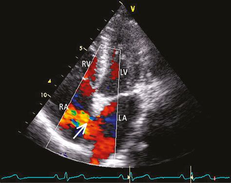 Figure 0310133 Transthoracic Echocardiography Tte 4 Chamber View