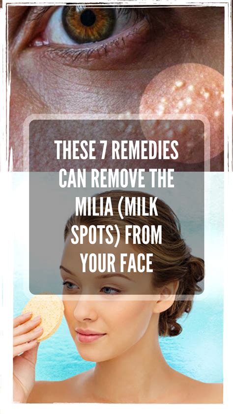 These 7 Remedies Can Remove The Milia Milk Spots From Your Face