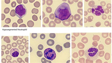 Other Findings In Peripheral Blood Smear Youtube