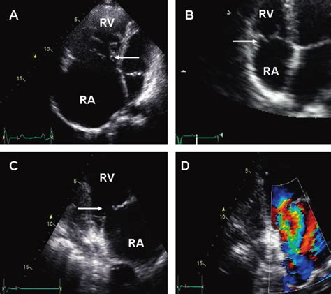 A Ebsteins Anomaly Of The Tricuspid Valve The Septal Attachment Of