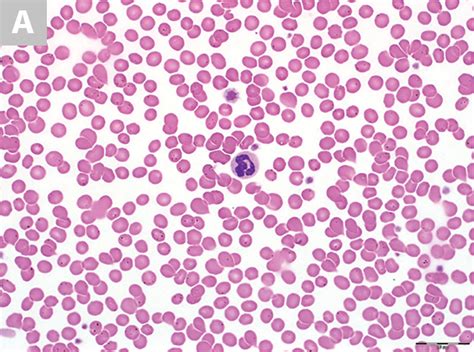High platelet counts mean that blood will clot easily and that can be dangerous of itself. Blood Smear Platelet Evaluation & Interpretation ...