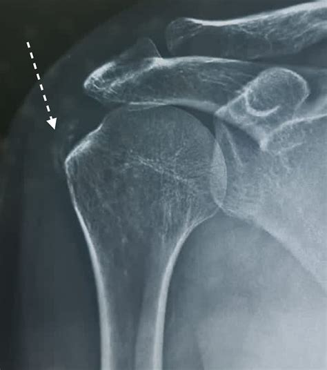 Case 1 Anteroposterior X Ray Of The Shoulder Showing Calcification In