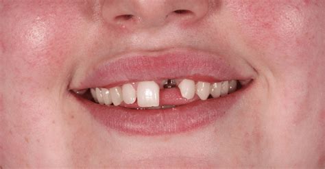 Single Tooth Dental Implants Springmount Dental And Aesthetics