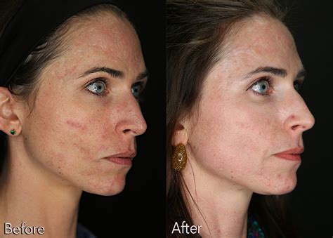 Acne Scar Treatment Before And After Kaado Md Aesthetics Anti Aging Medicine