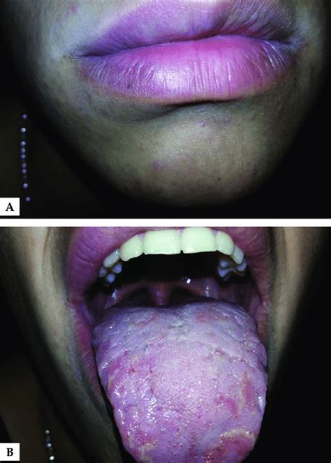 Lower Lip Swelling Treatment