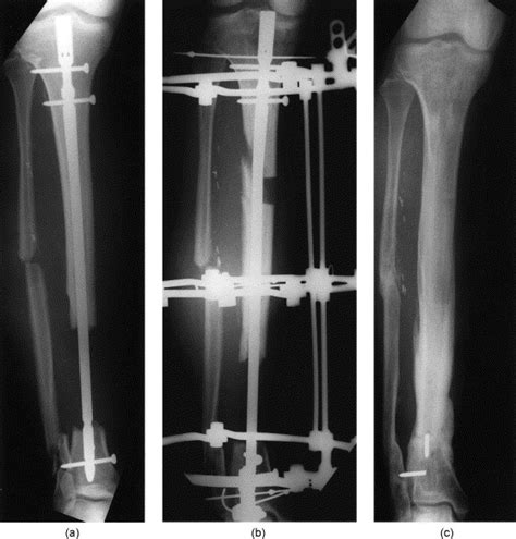 Segmental Tibial Fractures An Assessment Of Procedures In 27 Cases
