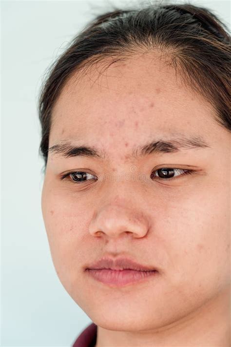 Close Up Of Young Asian Woman Worry About Her Face When She Has