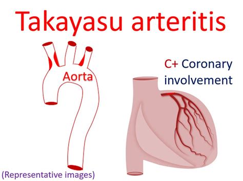 Angiographic Classification Of Takayasu Arteritis All About