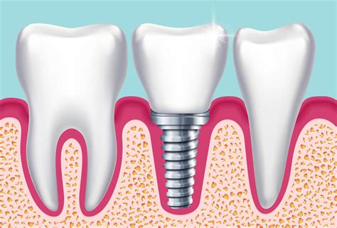 Benötigt der zahn eine wurzelbehandlung müssen alle. Implantate: können auch Risiken und Nebenwirkungen haben ...