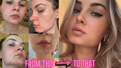 My Accutane Journey How I Cleared My Skin In 3 Month Aknenormin Edition Youtube
