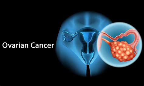 Ovarian Cancer Symptoms Causes Prevention Sachin Marda Best