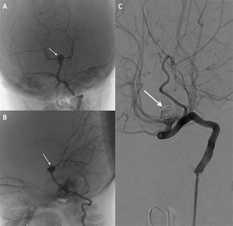 Rare Case Of Basilar Artery Aneurysm In A Young Child Bmj Case Reports
