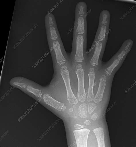 Normal Hand Of Child X Ray Stock Image C0393336 Science Photo