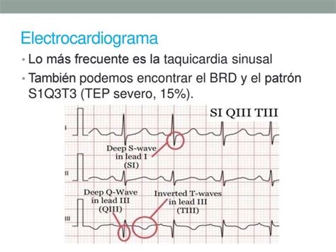 Tromboembolismo Pulmonar Flashcards Quizlet