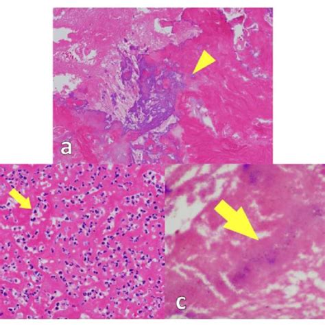 Pdf Infective Calcified Amorphous Tumor On Mitral Valve And Critical