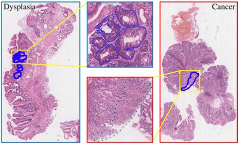 Illustration Of Whole Slide Gastric Histopathology Images The Left And