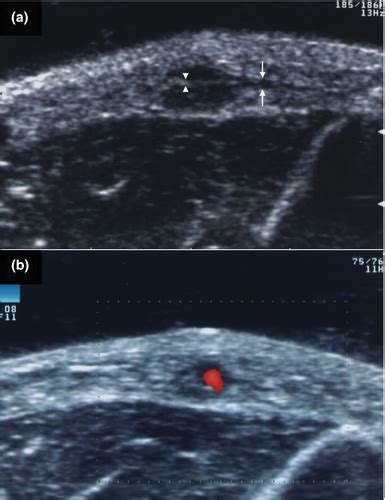 Ultrasonography Findings Of Intradermal Nodular Fasciitis A Rare Case