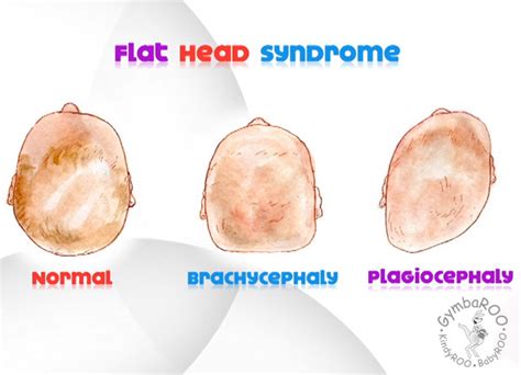 Positioning Baby To Prevent A Flattened Head Shape Plagiocephaly