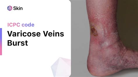 When Varicose Veins Burst Managing Ruptured Veins And Bleeding