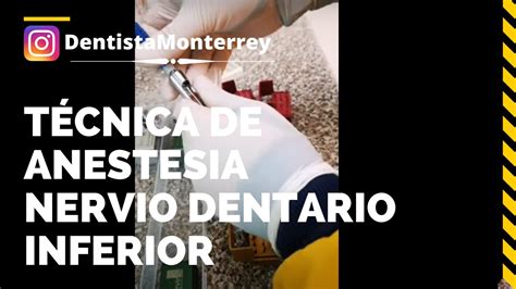 💉tÉcnica De Anestesia Dental👅nervio Dentario Inferior Dentaltips
