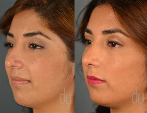 Rhinoplasty Nose Job Before And After Recovery Experience Beverly