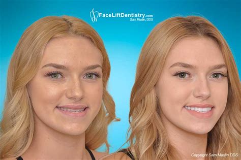The best alternative can be invisalign or clear aligner. Underbite Correction - No Drilling, No Surgery, In 3 Weeks